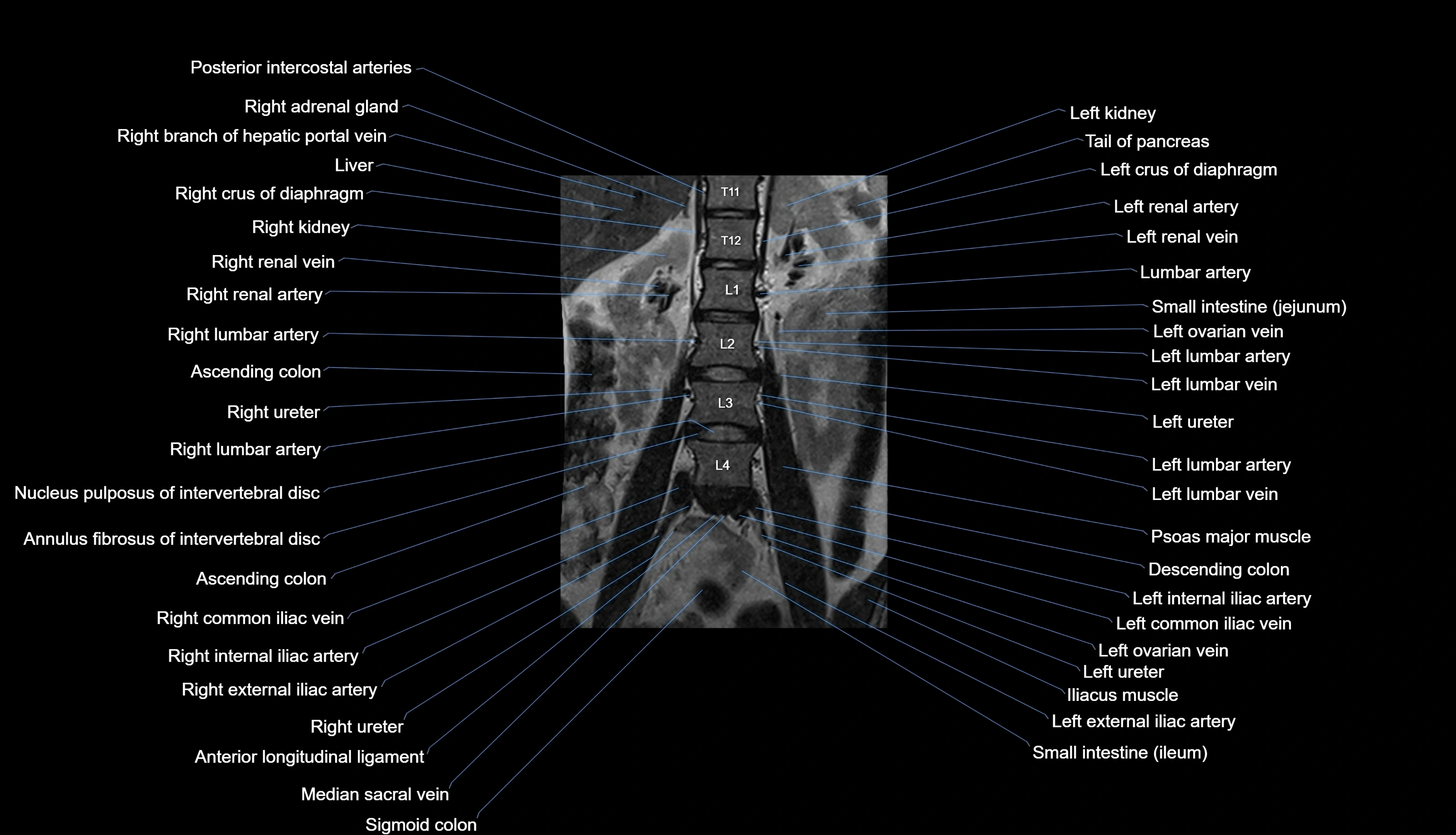MRI lumbar spine labelled coronal cross sectional anatomy 3T radiology-img-00001-00008.webp